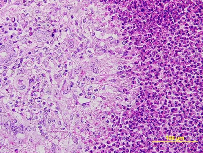 massive eosinophilic granulomatus hepatitis caused by cysticercosis