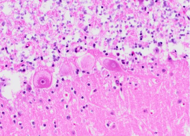 Photomicrograph of bovine brain showing foamy vacuolation of neural cytoplasm