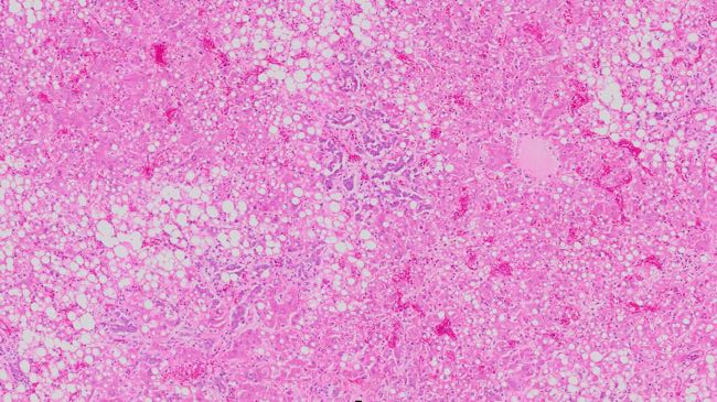Photomicrograph of bovine liver section showing fatty degernaration and biliary proliferation
