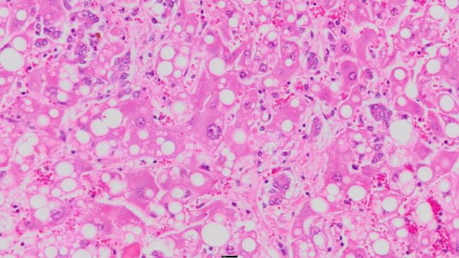 Photomicrograph of bovine liver section showing fatty degeneration, biliary proliferation and megaloscytosis