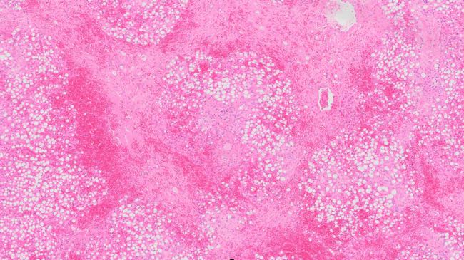 Photomicrograph of histological section of bovine liver showing hepatocyte loss