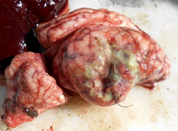 bacterial meningitis brain close up