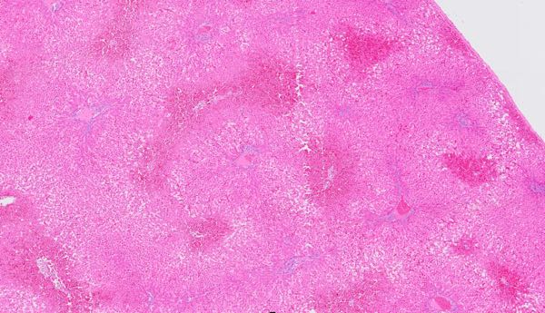 Photomicrograph of ovine liver showing hepatocyte injury and haemorrhage